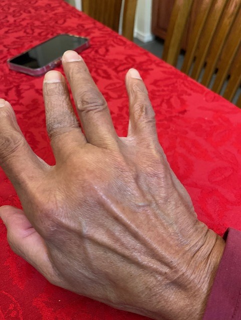 Close-up of trigger finger before treatment, showing flexed digit and irritated skin.